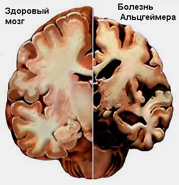 Brain_Alzheimer.jpg